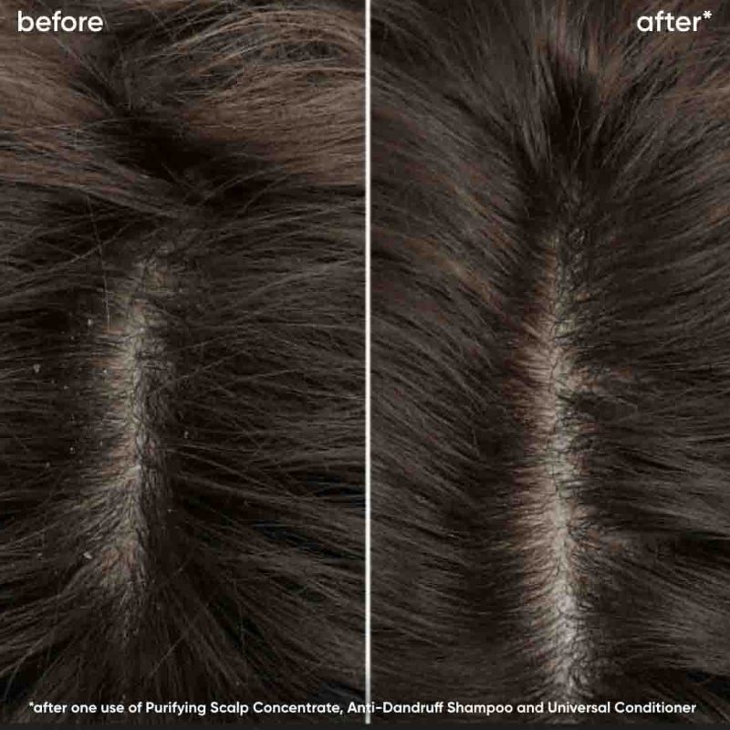 Biolage 2023 Scalp Sync Dandruff Prone Before After Zach Closeup 968x828